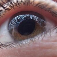 Glaucoma, male strisciante che ruba la vista a poco a poco: come prevenirlo