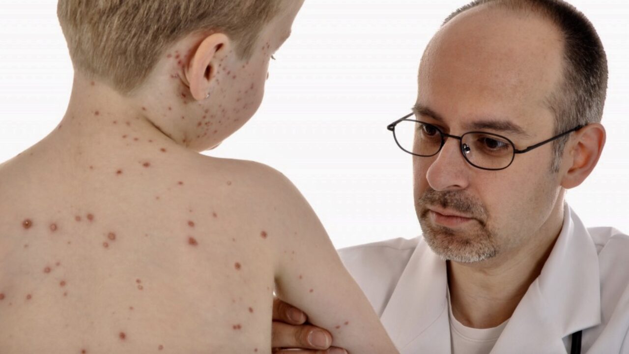 Morbillo, nel 2017 i casi sono stati sei volte più numerosi dell’anno prima