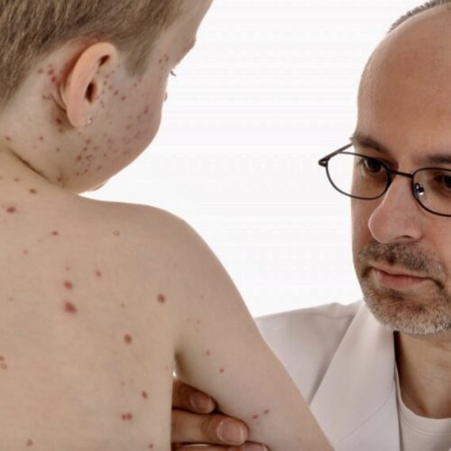 Morbillo, nel 2017 i casi sono stati sei volte più numerosi dell’anno prima