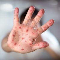 Da gennaio 1.334 casi di morbillo, oltre 50 i bimbi sotto i 12 mesi